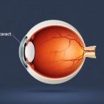 Small Incision Cataract Surgery